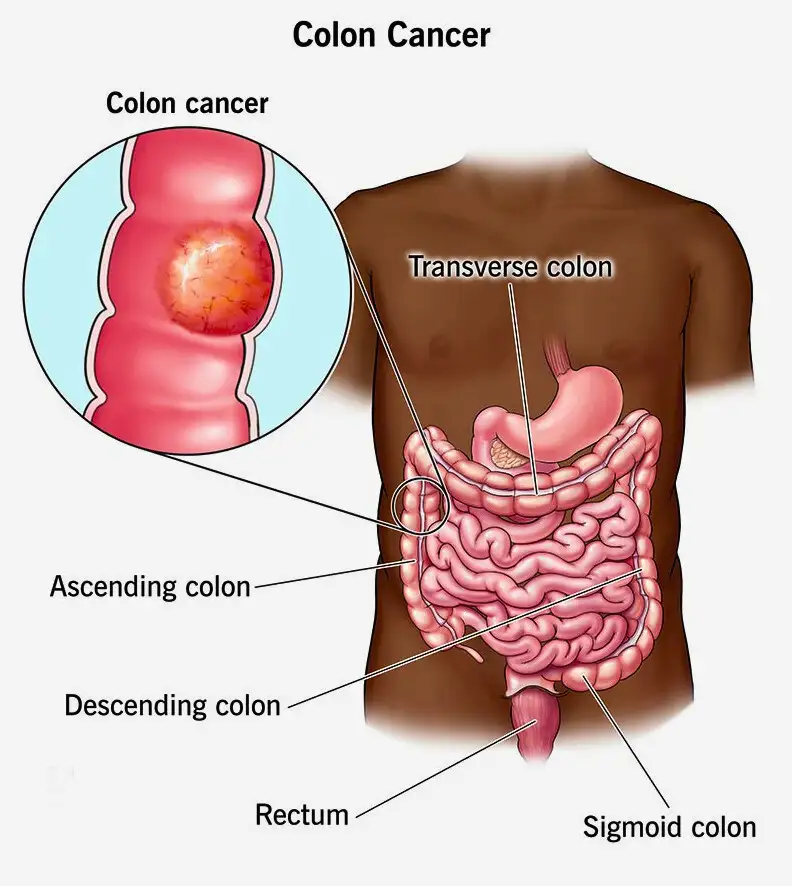 Chemotherapy for Colon Cancer