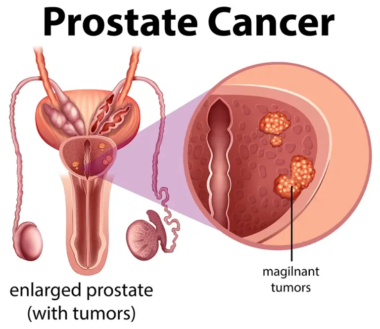 Prostate Cancer: A Brief Overview