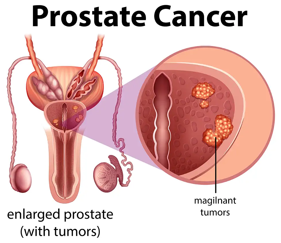 prostate-cancer