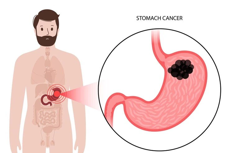 Gastrointestinal Cancer Treatment