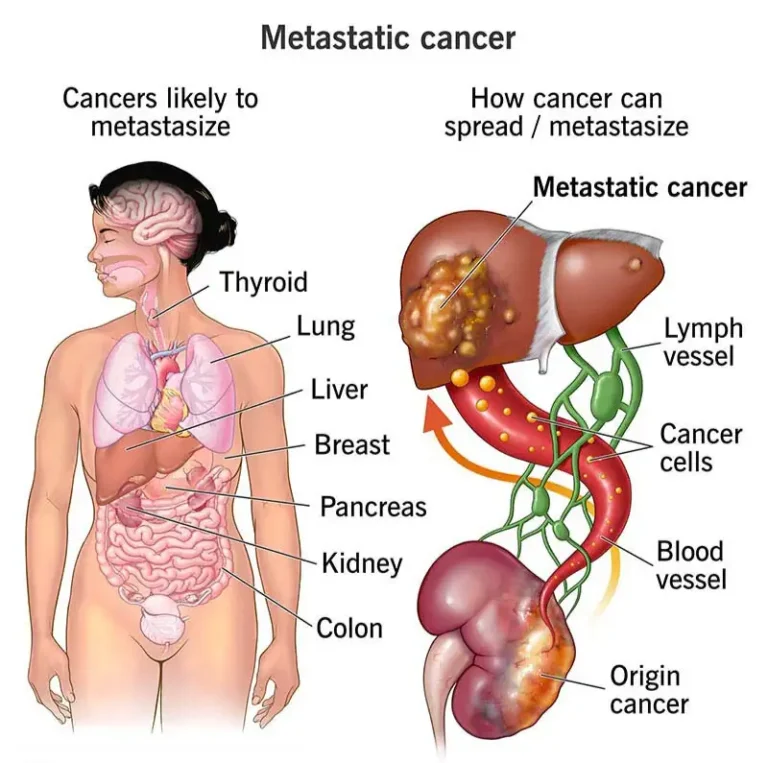 Lung Cancer Treatment Options for Advanced/Metastatic Stages: A Guide to Personalized Care